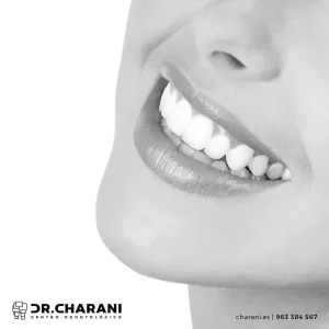 blanqueamiento-dental