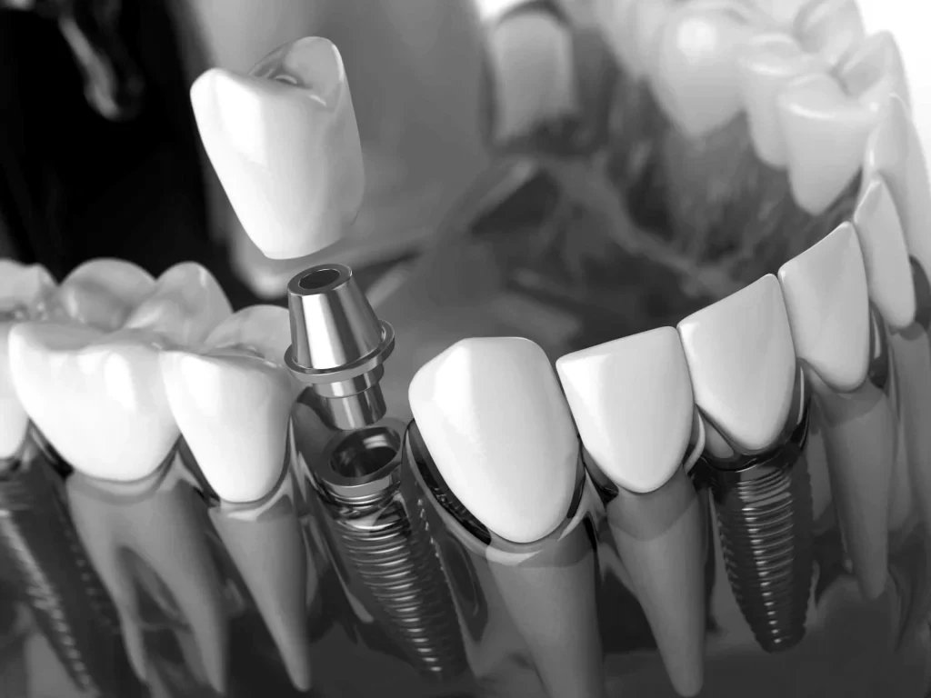 implantes-dentales-valencia