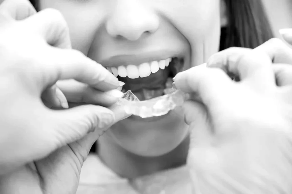Invisalign