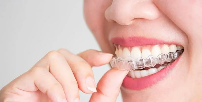 Invisalign en valencia 1 - 10 aspectos que debes conocer sobre la técnica Invisalign