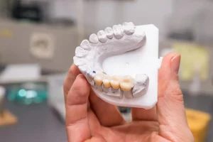 Cuánto dura un puente dental