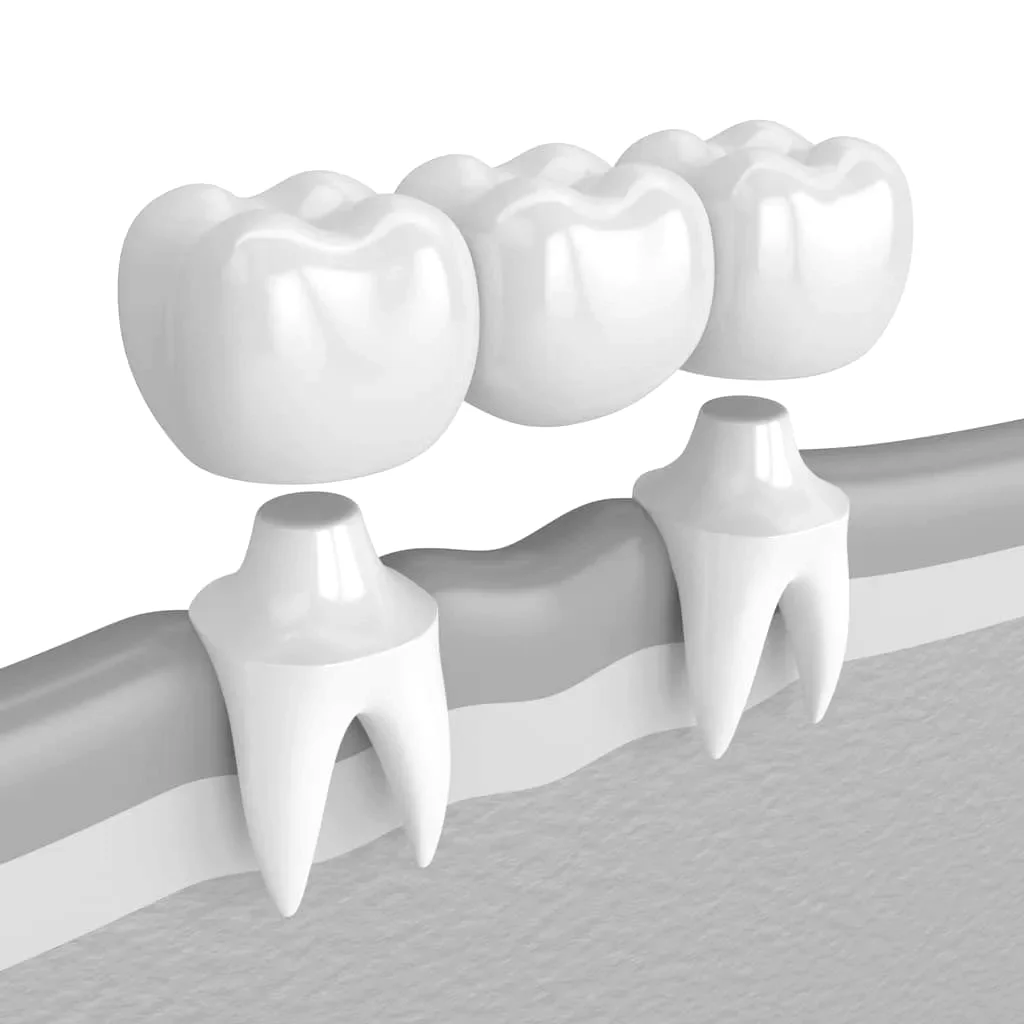 Cuánto dura un puente dental
