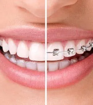 Invisalign o brackets