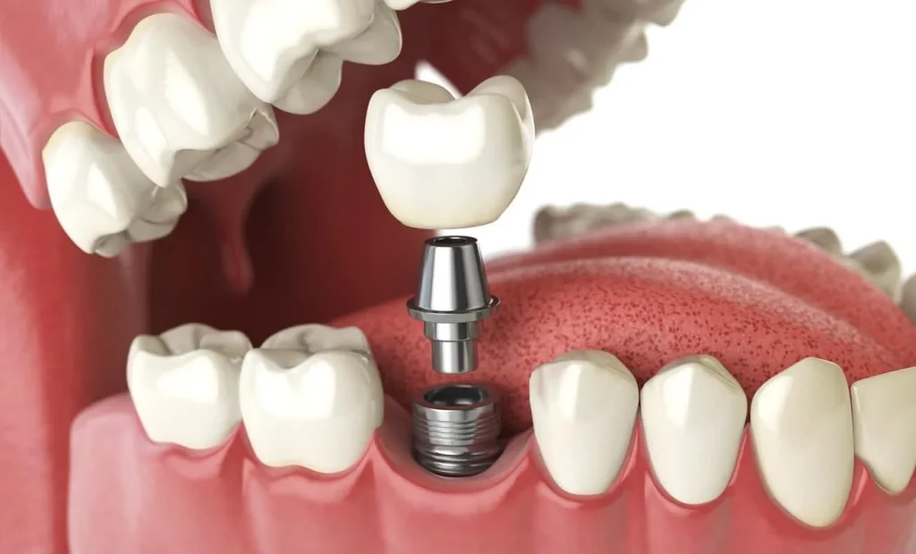Cuidar los implantes dentales