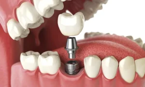 Cuidar los implantes dentales