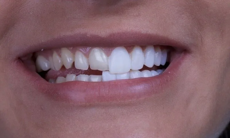Todo sobre las carillas dentales