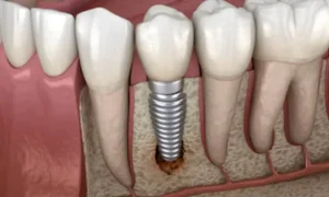 Qué es la periimplantitis
