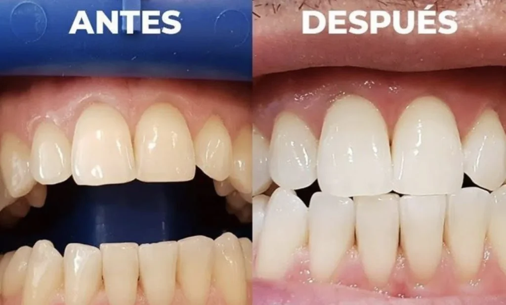 Preguntas sobre el blanqueamiento dental