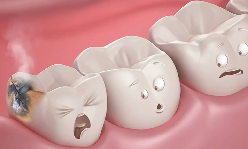 Señales de que puedes tener una caries