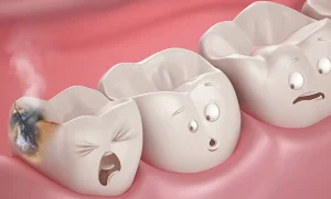 Señales de que puedes tener una caries