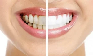 Manchas marrones en los dientes
