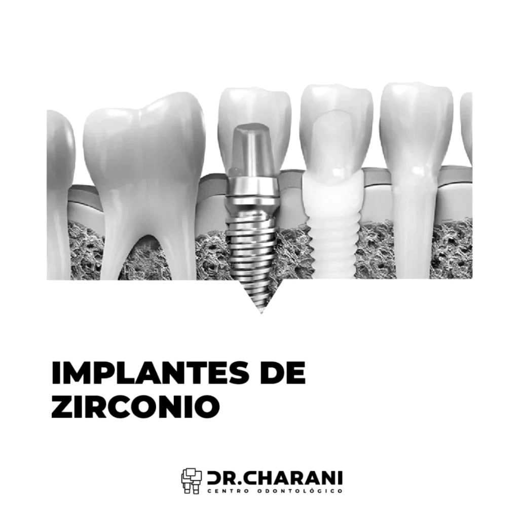 Tipos de implantes dentales y sus beneficios