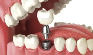 Tipos de implantes dentales en valencia