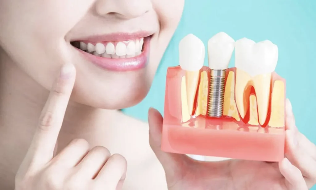 Cirugía de implantes dentales en Valencia