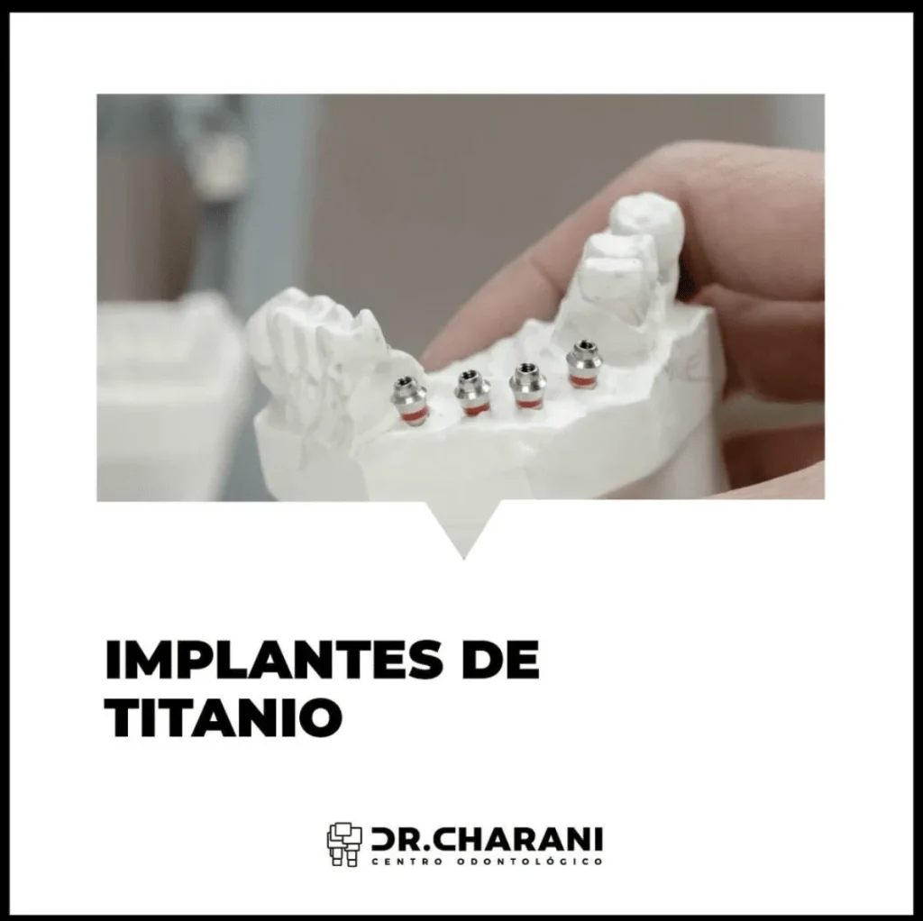 Las ventajas de un implante dental