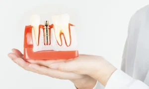 Por qué ponerse un implante dental