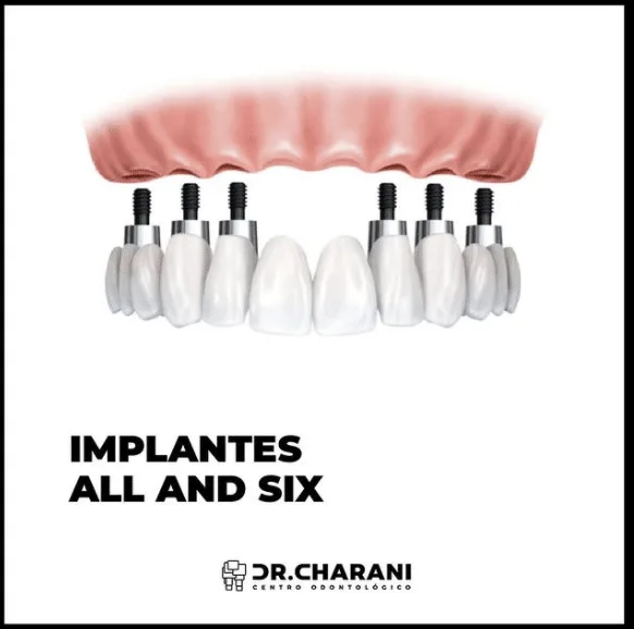 ¿Conoces la mejor clínica de implantes en Valencia?
