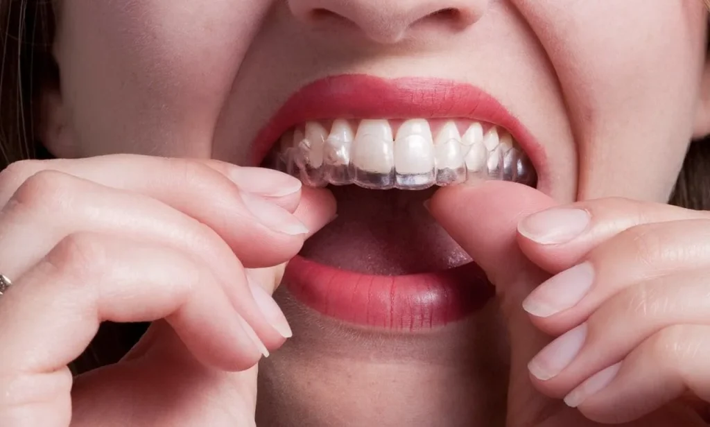 Ortodoncia sin brackets