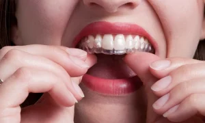 Ortodoncia sin brackets