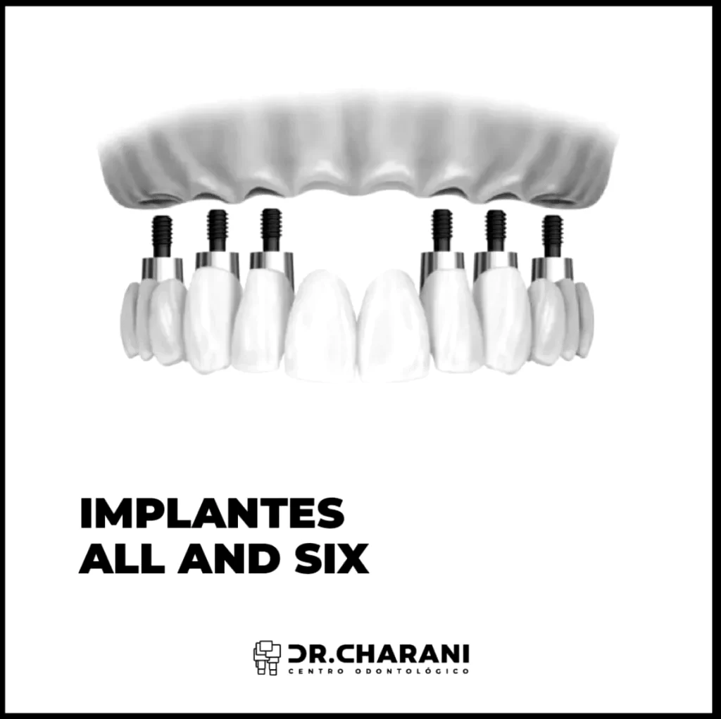 Los implantes dentales ¿qué necesitas saber?