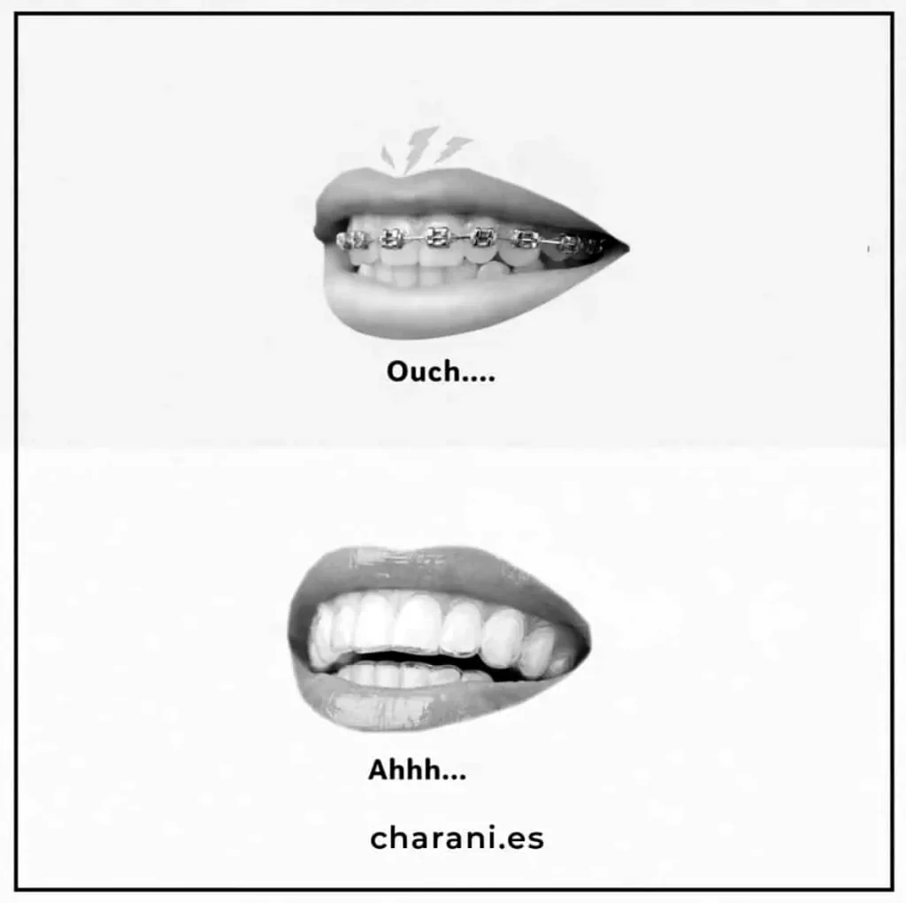 La solución que buscas: aparato de dientes invisible