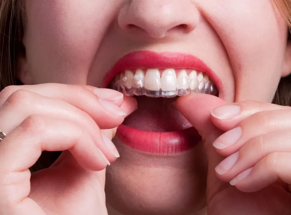 promocion invisalign valencia