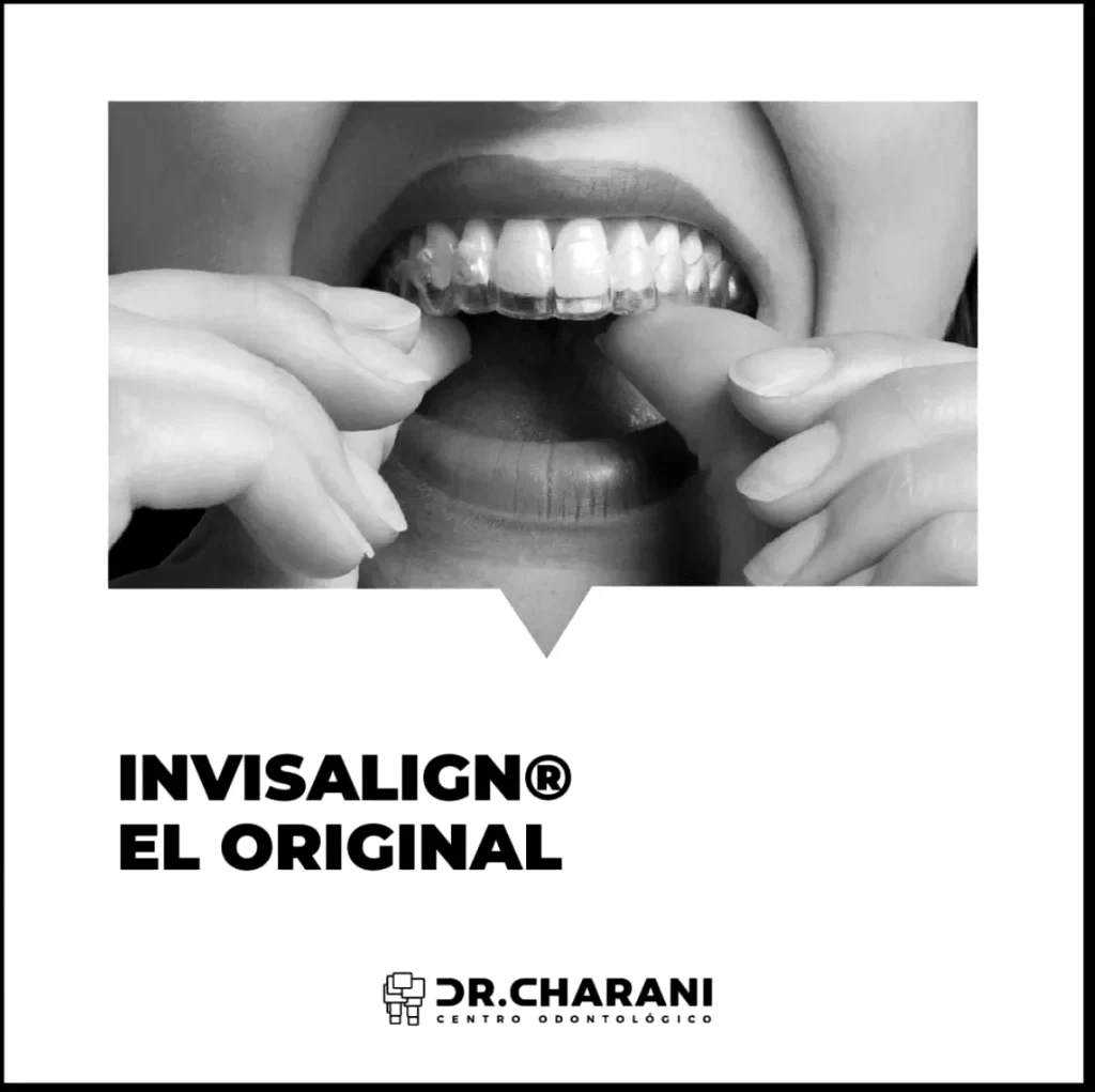 La solución de los alineadores invisibles