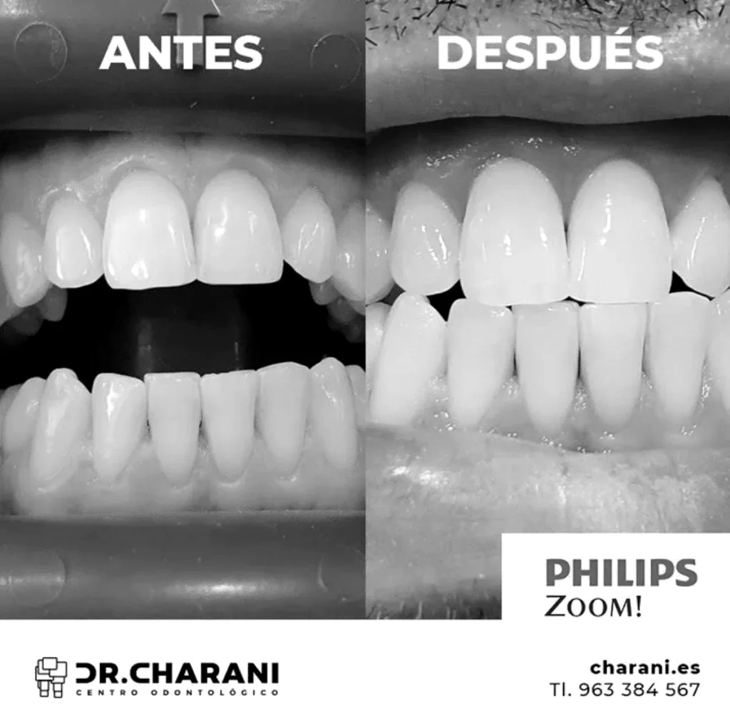 Blanqueamiento dental Clinica Charani
