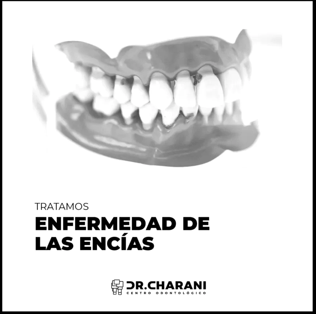 Formas de detener la gingivitis o el sangrado de encías
