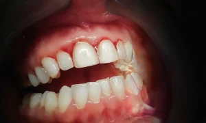 Formas de detener la gingivitis