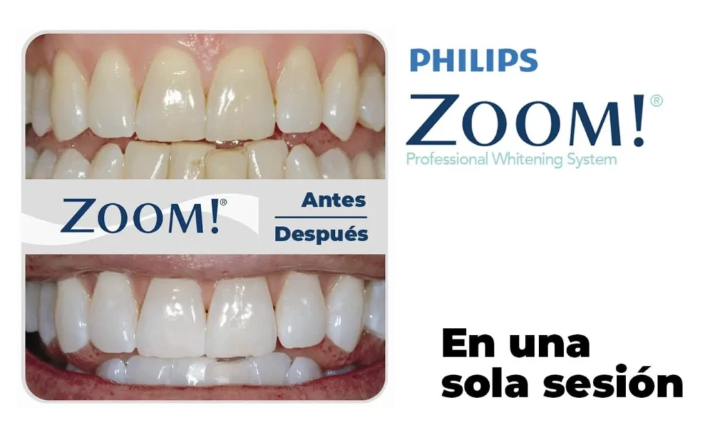 Blanqueamiento philips zoom valencia