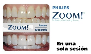 Blanqueamiento philips zoom valencia
