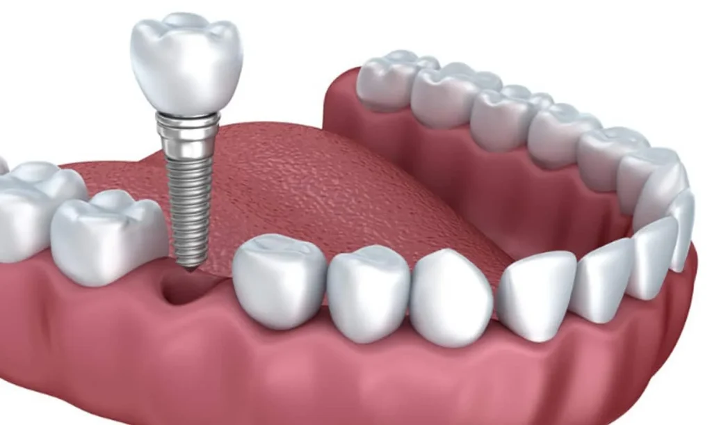 Implantes de dientes sin cirugía