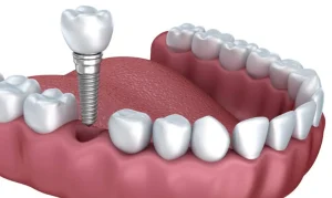 Implantes de dientes sin cirugía