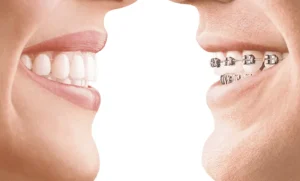 Brackets vs Invisalign