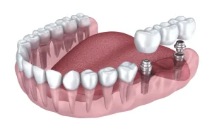 Puente dental