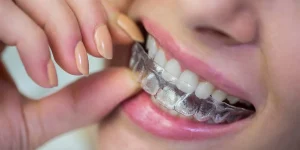 historia invisalign