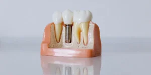 implantes carga inmediata