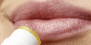 herpes labial