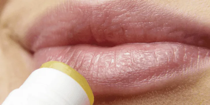 herpes labial