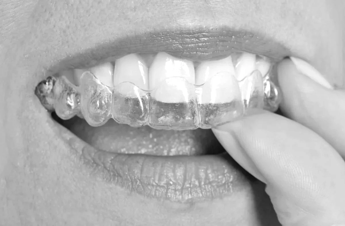 Ortodoncia Invisalign en Valencia