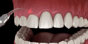 gingivectomia