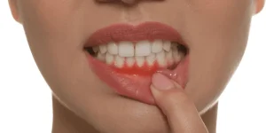 retracción de las encías