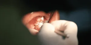 Las caries siempre duelen