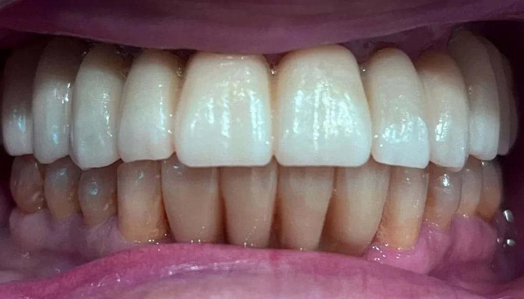 Después: restauración con implantes dentales y coronas de circonio