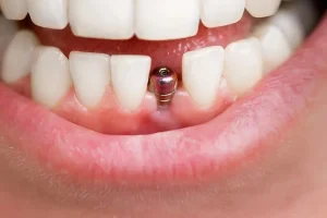 Boca mujer mostrando su implante dental