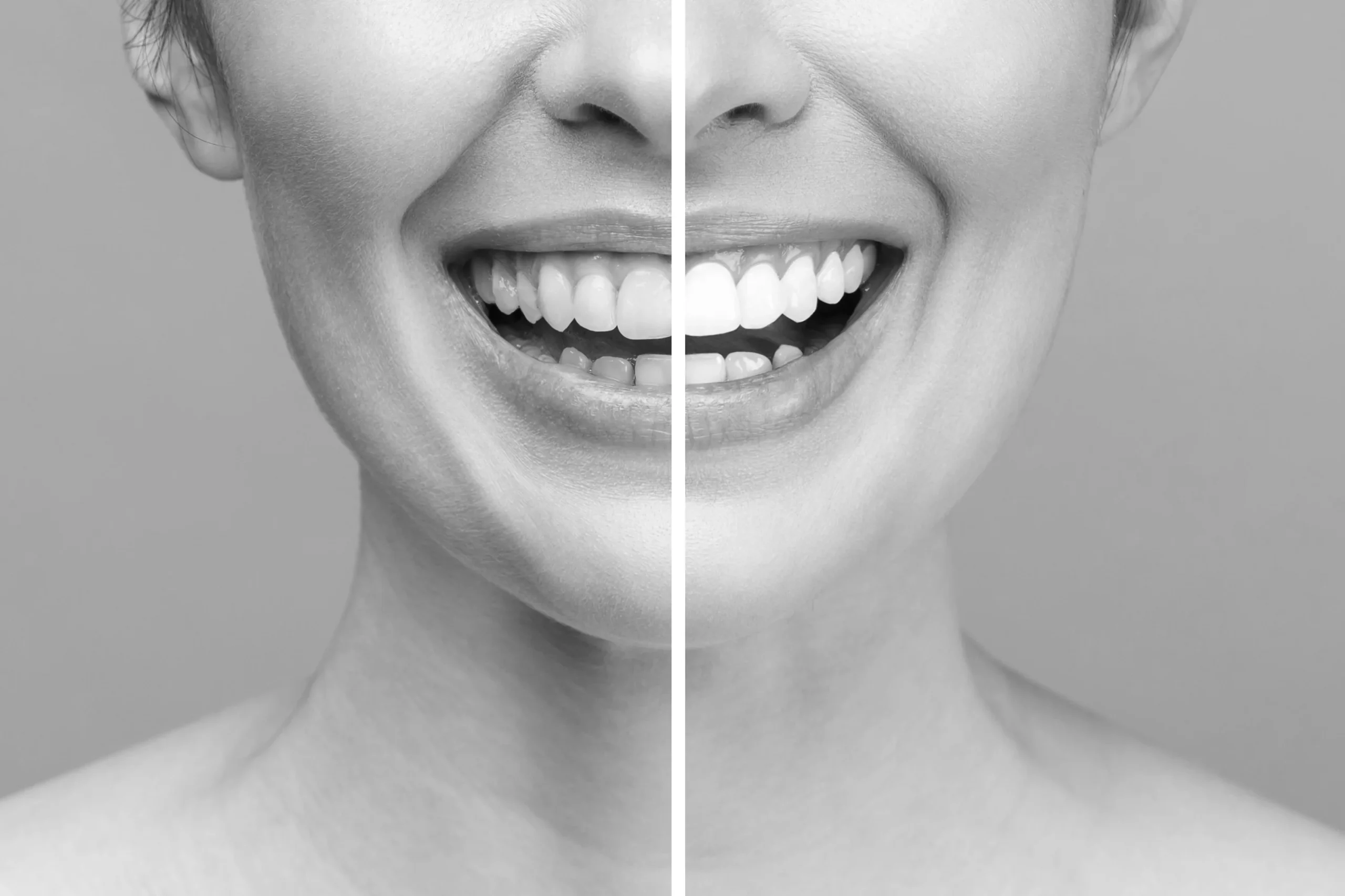 Blanqueamiento dental en Valencia - Clínica Dental Charani