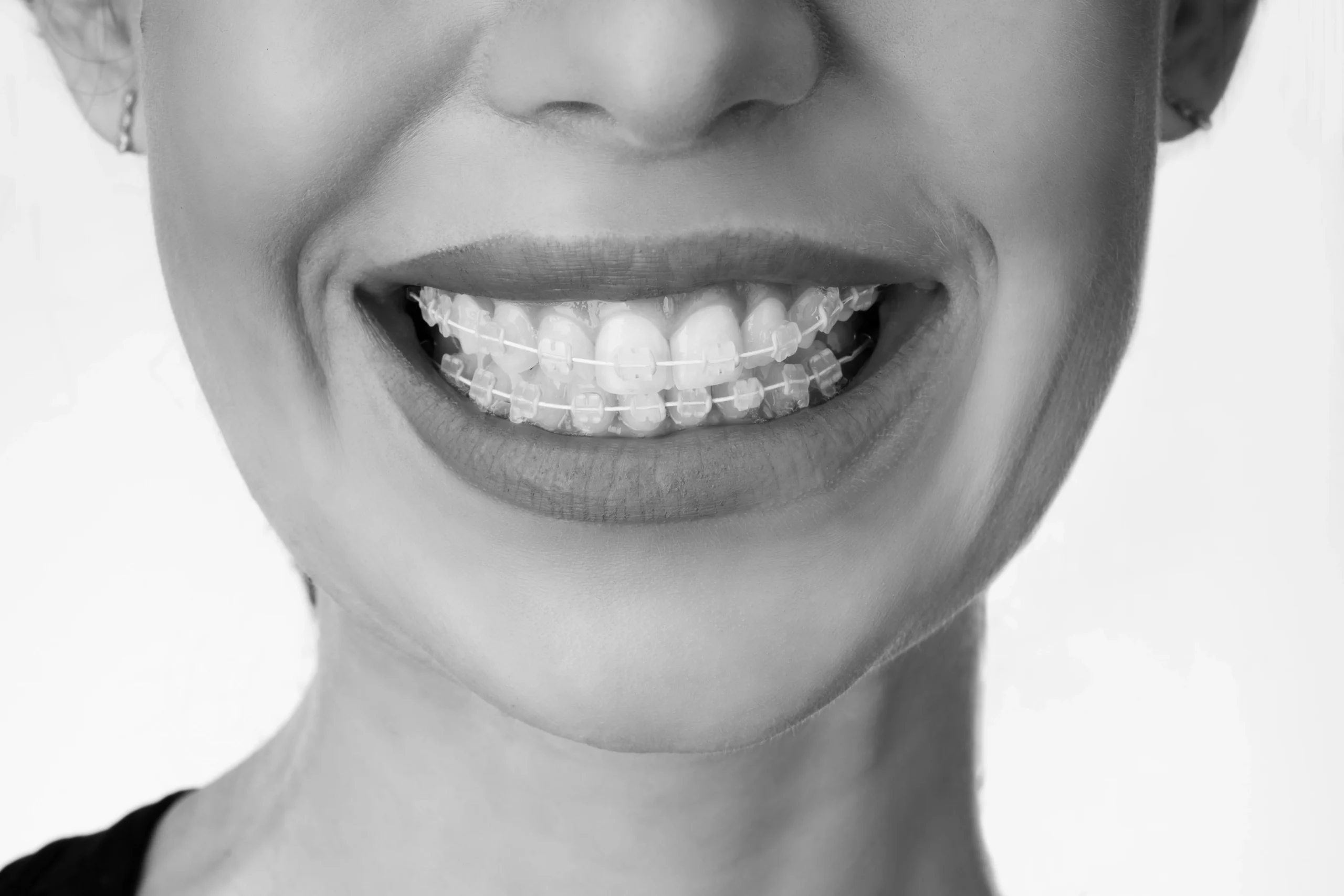 Brackets estéticos de porcelana
