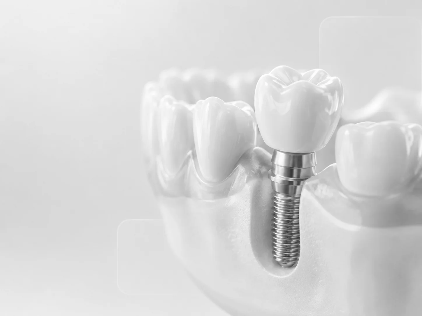 Implante dental de titanio, render 3D