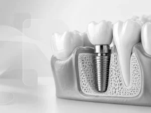 Implantologia dental implantes dentales valencia 2